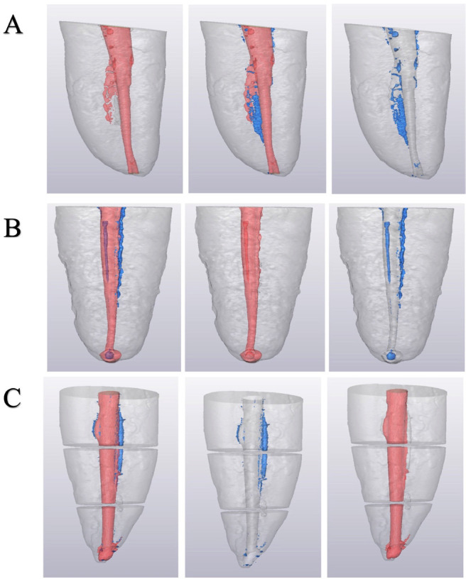 Single cone and bioceramic sealer in oval canals: Efficiency endodontic obturation.