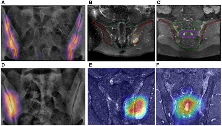 AI for imaging evaluation in rheumatology: applications of radiomics and computer vision-current status, future prospects and potential challenges.