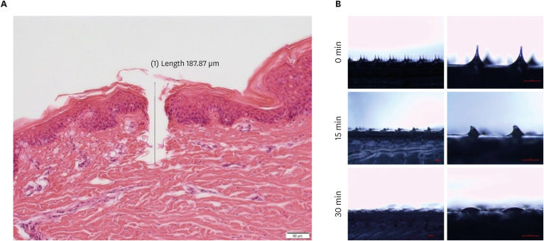 Additional Use of Hyaluronic Acid-Based Dissolving Microneedle Patches to Treat Psoriatic Plaques: A Randomized Controlled Trial.