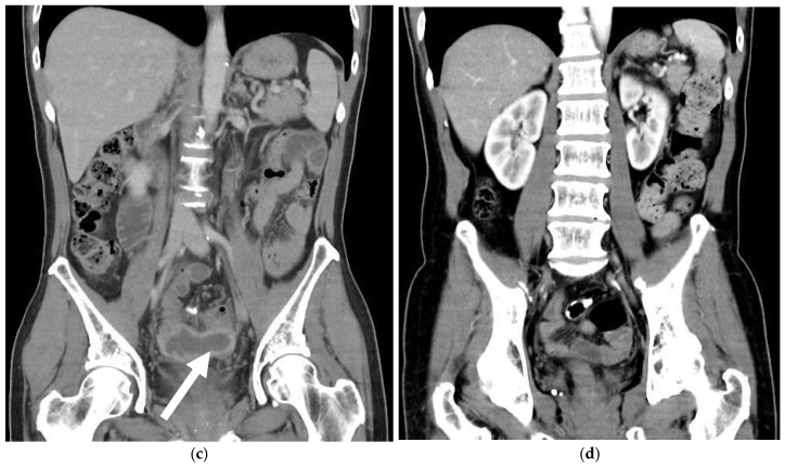 Neovaginal Perforation in Sigmoid Vaginoplasty: An Underrecognized Complication-A Literature Review.