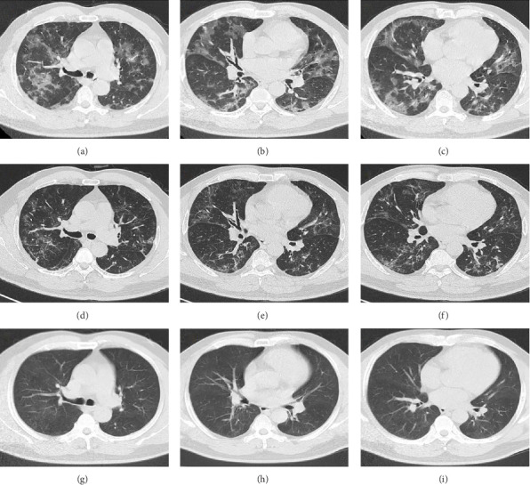 A Case Report of COVID-19 With Tracheobronchial Aspergillosis.