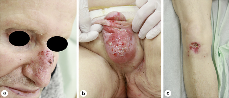 Therapy-Resistant Erosions in the Genital Area of Elderly Patients: A Differential Diagnostic Challenge - A Case Report.