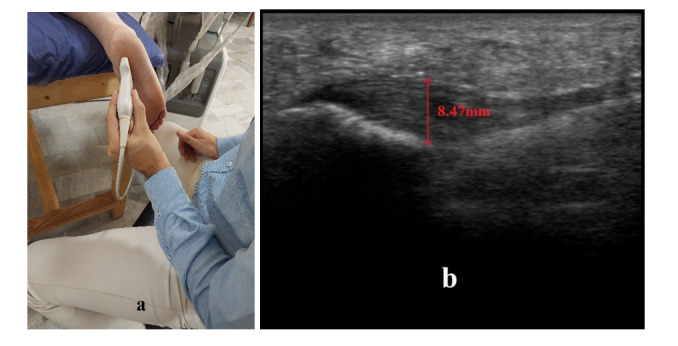 Sonographic Evaluation of the Superficial Back Line Myofascial Release in Plantar Fasciitis: A Single-Blind Randomized Controlled Trial.