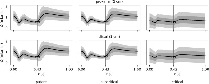 Flow-Based Coronary Artery Bypass Graft Patency Metrics: Uncertainty Quantification Simulations to Guide Development.