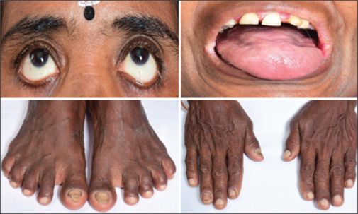Unmasking Plummer-Vinson Syndrome: A Rare Case Report.