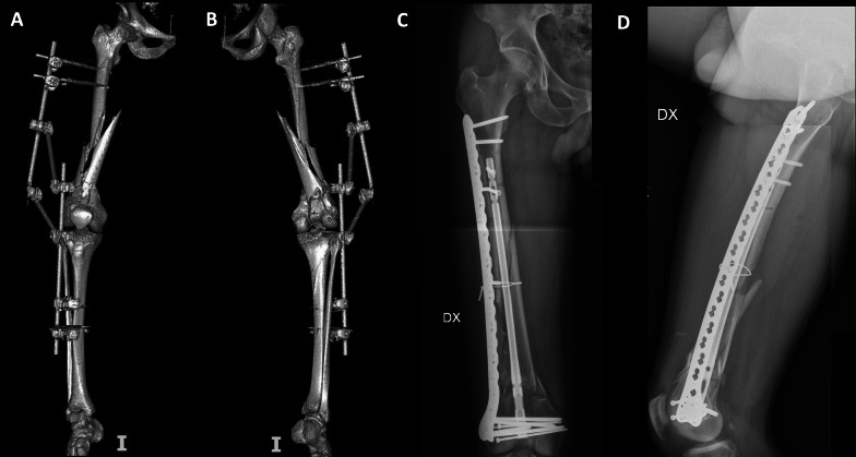 Double plating versus nail-plate construct in AO 33C distal femur fractures: treatment choice affects knee alignment, clinical outcomes, and quality of life-a multicenter study.
