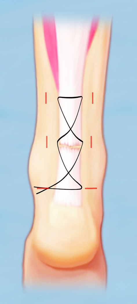 Comparison of open, percutaneous, or mini-open repair in the treatment of Achilles tendon ruptures: a systematic review and meta-analysis based on comparison studies.