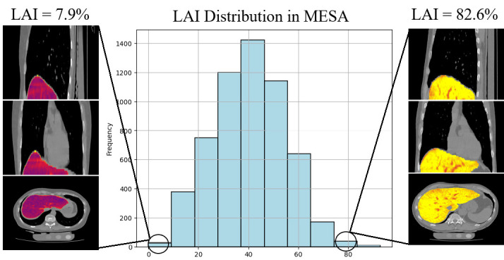 AI-enabled opportunistic measurement of liver steatosis in coronary artery calcium scans predicts cardiovascular events and all-cause mortality: an AI-CVD study within the Multi-Ethnic Study of Atherosclerosis (MESA).