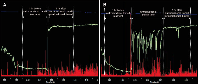 Panenteric Transit Times and Contractile Activity in Diabetic Gastroenteropathy.