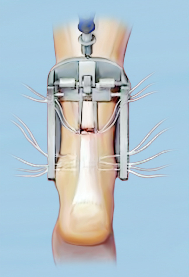 Comparison of open, percutaneous, or mini-open repair in the treatment of Achilles tendon ruptures: a systematic review and meta-analysis based on comparison studies.