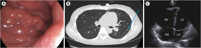 Pulmonary Tumor Thrombotic Microangiopathy Associated With Gastric Cancer: Clinical Characteristics and Outcomes.