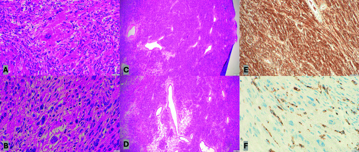 Leiomyoma with Bizarre Nuclei and Hereditary Leiomyomatosis and Renal Cell Carcinoma.