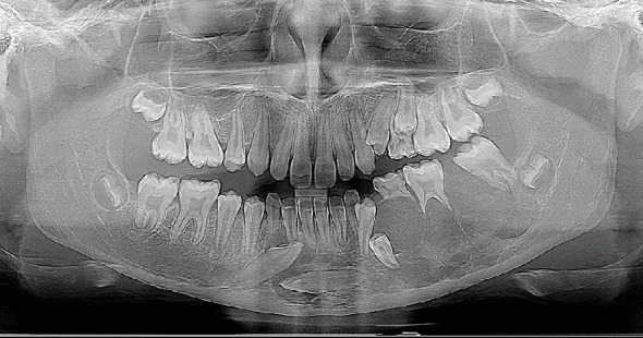 Exploring Paediatric Jaw Osteosarcoma: A Detailed Case Report of a 12-Year-Old Girl and Review of the Literature.