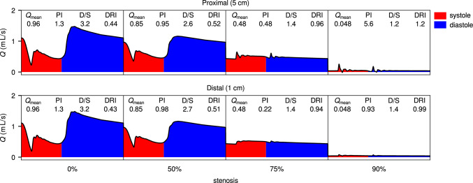 Flow-Based Coronary Artery Bypass Graft Patency Metrics: Uncertainty Quantification Simulations to Guide Development.