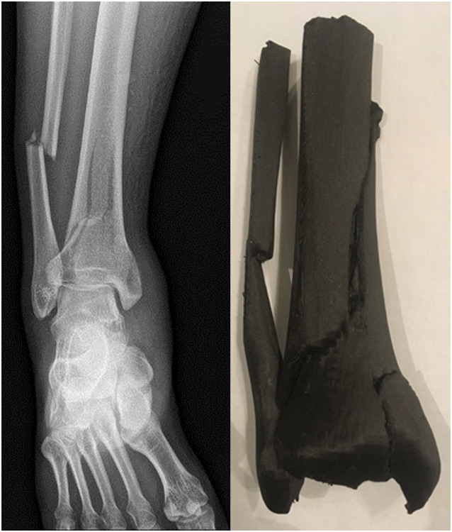 The expanding role of additive manufacturing in orthopaedic traumatology.