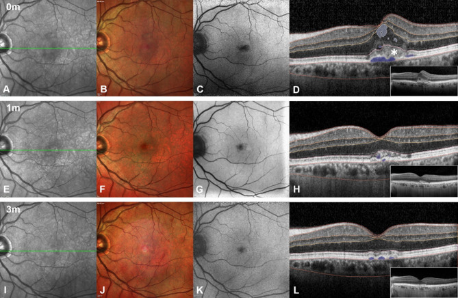 Early real-world outcomes of intravitreal aflibercept 8 mg in treatment-Naïve neovascular AMD: AI-assisted fluid volume analysis.