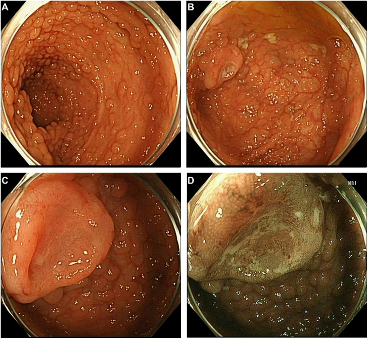 Family adenomatous polyposis come across dome type adenocarcinoma: a case report and literature review.
