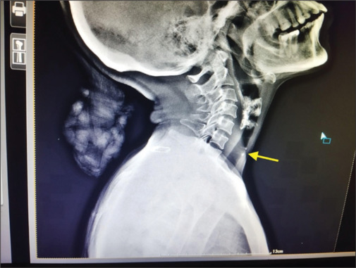 Unmasking Plummer-Vinson Syndrome: A Rare Case Report.