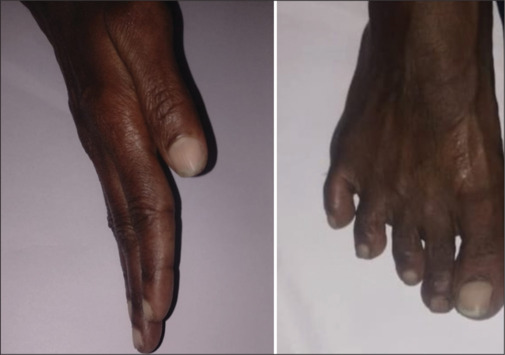 Unmasking Plummer-Vinson Syndrome: A Rare Case Report.