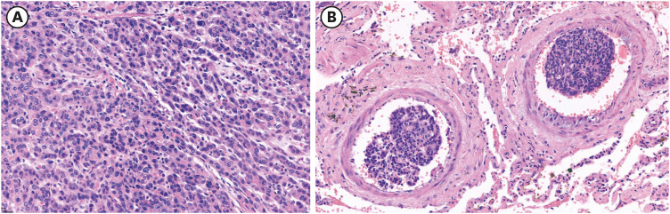 Pulmonary Tumor Thrombotic Microangiopathy Associated With Gastric Cancer: Clinical Characteristics and Outcomes.