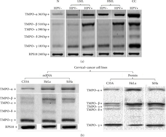 Thymopoietin-<i>α</i>, -<i>β</i>, and -<i>γ</i> Isoforms Increased Expression in Cervical Cancer Cells.