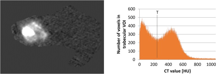AGN1 local osteo-enhancement procedure increases proximal femur volumetric bone mineral density of women with post-menopausal osteoporosis as assessed by quantitative computed tomography analysis.