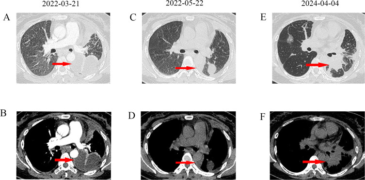Combination of Aumolertinib, Dabrafenib, and Trametinib for a Patient with Advanced Lung Adenocarcinoma with an Osimertinib-Induced BRAF V600E Mutation: A Case Report.