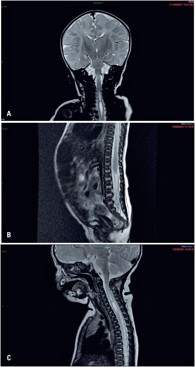 Moebius Syndrome associated with syringomyelia: a case report.