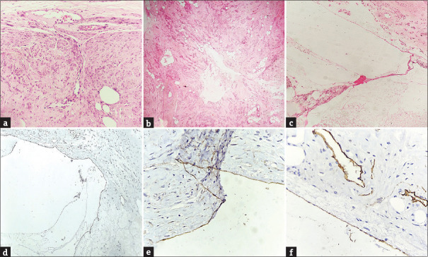 Cervical Lymphangiolipoleiomyoma: An Unusual Offender at a Usual Destination - Case Report and Literature Review.