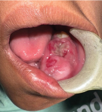 Exploring Paediatric Jaw Osteosarcoma: A Detailed Case Report of a 12-Year-Old Girl and Review of the Literature.