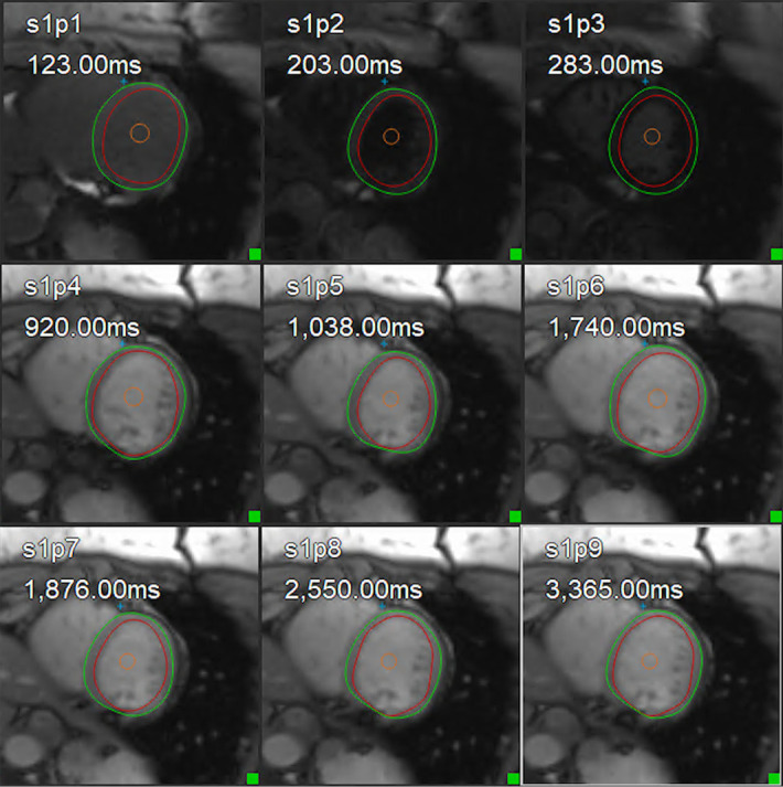 Non-invasive tissue characterization in children and young adults with aortic coarctation-an MRI-based prospective study.