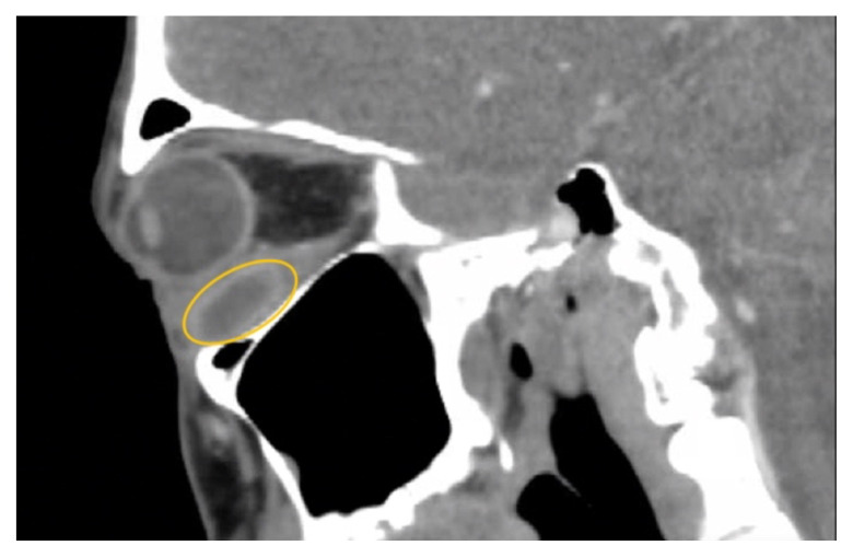 A Case Report of Inferior Rectus Abscess.