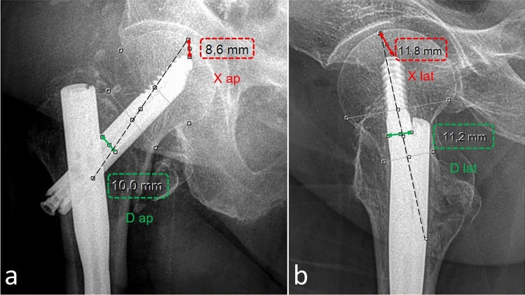Predicting mechanical complications in proximal femoral nailing for elderly patients: a radiological scoring system based on a single-centre retrospective cohort with 586 cases.