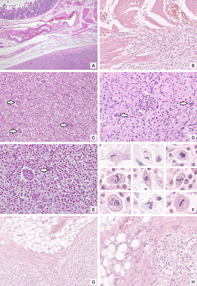 From benign appearance to malignant truth: a case report of mesenteric dedifferentiated liposarcoma with inflammatory myofibroblastic tumor-like features.