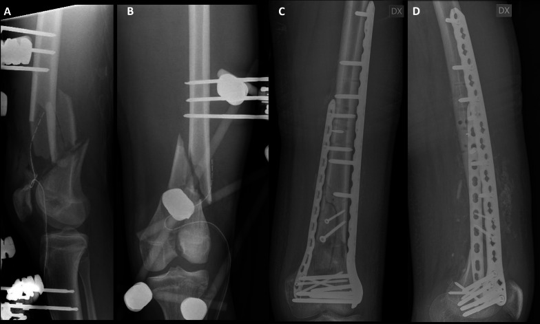 Double plating versus nail-plate construct in AO 33C distal femur fractures: treatment choice affects knee alignment, clinical outcomes, and quality of life-a multicenter study.