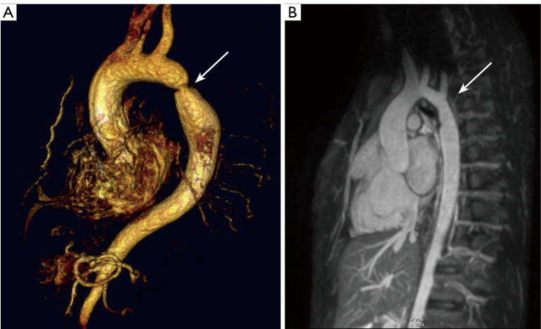 Non-invasive tissue characterization in children and young adults with aortic coarctation-an MRI-based prospective study.