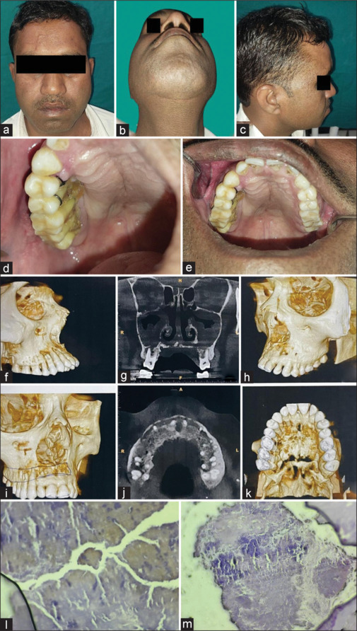Actinomycotic Osteomyelitis in the Maxilla: A Rare Case Report of Postdengue Complication in Diabetic Patients.
