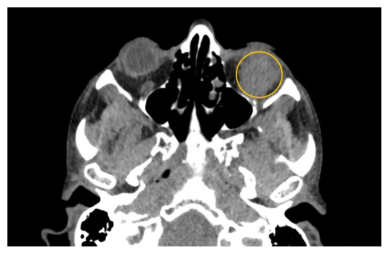 A Case Report of Inferior Rectus Abscess.