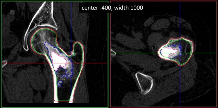 AGN1 local osteo-enhancement procedure increases proximal femur volumetric bone mineral density of women with post-menopausal osteoporosis as assessed by quantitative computed tomography analysis.