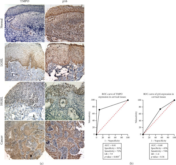 Thymopoietin-<i>α</i>, -<i>β</i>, and -<i>γ</i> Isoforms Increased Expression in Cervical Cancer Cells.