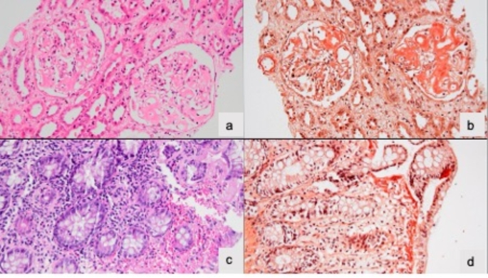 Amyloidosis in Human Inborn Errors of Immunity Predicts Poor Prognosis.