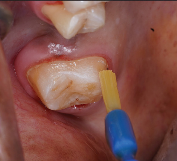Comparative evaluation of application of bioactive glass desensitizer and dentin bonding agent on prepared vital tooth in postoperative sensitivity at varying time period before cementation: An observational study.