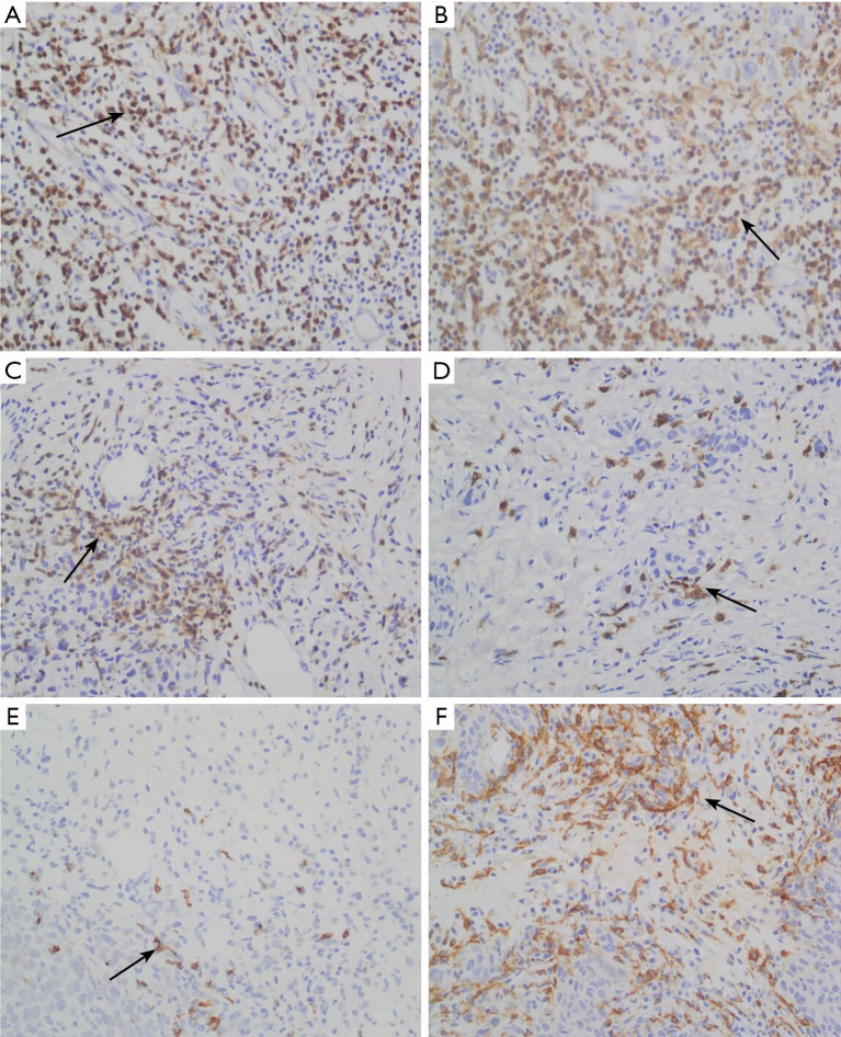 Correlation study of tumor-infiltrating lymphocytes (TILs) and subtypes analysis before and after neoadjuvant chemotherapy in triple-negative breast cancer.
