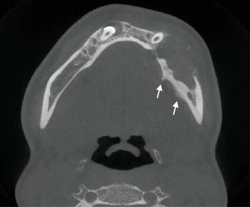 Exploring Paediatric Jaw Osteosarcoma: A Detailed Case Report of a 12-Year-Old Girl and Review of the Literature.