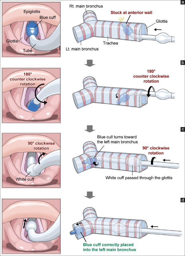Double-Lumen Tube Intubation Using the McGrath MAC Videolaryngoscope-Corkscrew Maneuver.