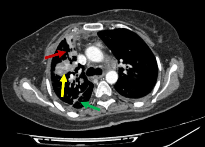 Failure of the tyrosine kinase inhibitors osimertinib and erlotinib to manage a patient with EGFR-mutant lung adenocarcinoma: a case report.