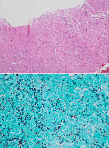 Acute Myelopathy as Initial Presentation of Disseminated Histoplasmosis: A Case Report.