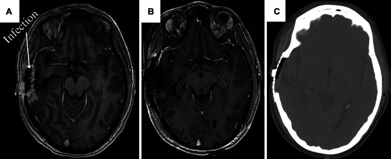 <b>Recurrent Glioblastoma Resection with Microvascular Free Flap Reconstruction and Associated GammaTile Implantation: A Personalized Approach with Oncologic and Reconstructive Integration</b>.