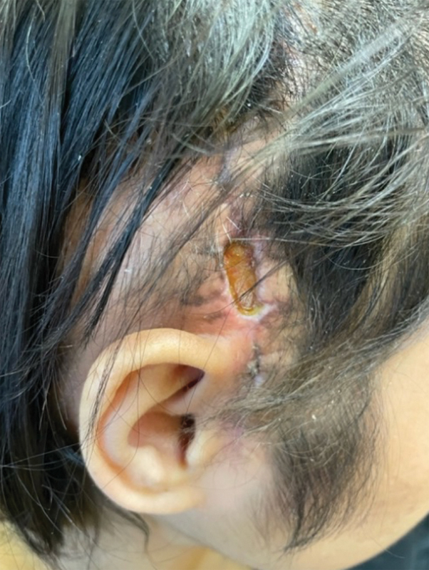 <b>Recurrent Glioblastoma Resection with Microvascular Free Flap Reconstruction and Associated GammaTile Implantation: A Personalized Approach with Oncologic and Reconstructive Integration</b>.