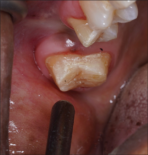 Comparative evaluation of application of bioactive glass desensitizer and dentin bonding agent on prepared vital tooth in postoperative sensitivity at varying time period before cementation: An observational study.